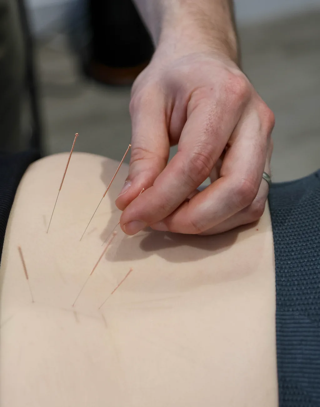 Medical acupuncture treatment at BetterMe